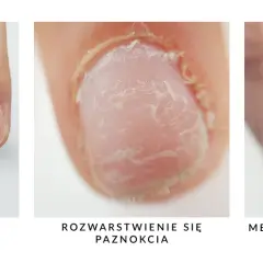 Jak wyrównać płytkę paznokcia i uniknąć nieestetycznych nierówności