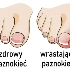 Jak wyciąć wrastający paznokieć i uniknąć bólu oraz powikłań