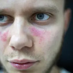 Czerwone plamy na policzkach mężczyzny, przypominające liszaj rumieniowaty, z błyszczącymi drobinkami.