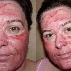 Jak bezpiecznie używać krwawego peelingu The Ordinary dla najlepszych efektów