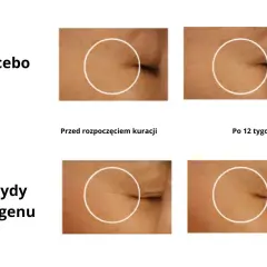 Porównanie skóry przed i po 12 tygodniach: placebo vs. peptydy kolagenu. Sprawdź collagen drink dr max opinie.