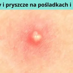 Jak powstaje pryszcz i co naprawdę wpływa na ich pojawianie się