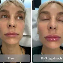 Kiedy efekt po kwasie hialuronowym? Oczekiwane rezultaty i czas działania
