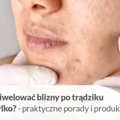 Skóra z bliznami po pryszczach, z tekstem "Jak zniwelować blizny po trądziku i nie tylko?".