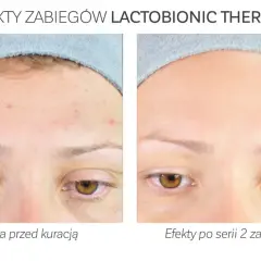 Przed i po zabiegu z kwasem laktobionowym: skóra z niedoskonałościami staje się gładka i czysta.