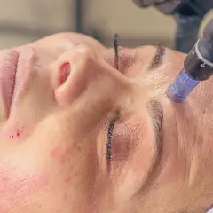 Mezoterapia bezigłowa czy mikrodermabrazja – który zabieg jest lepszy?