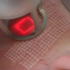 Jak wygląda zabieg laser frakcyjny? Efekty i co warto wiedzieć
