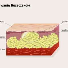 Przekrój skóry ukazujący powstawanie podskórnych gule tłuszczowe. Widoczna warstwa tłuszczu podskórnego, torebka i jama tłuszczaka.