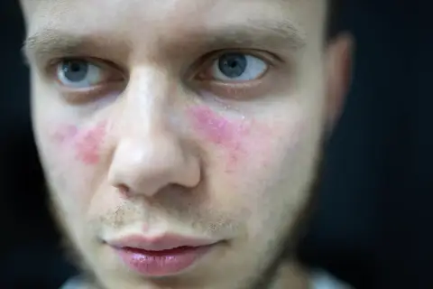 Czerwone plamy na policzkach mężczyzny, przypominające liszaj rumieniowaty, z błyszczącymi drobinkami.