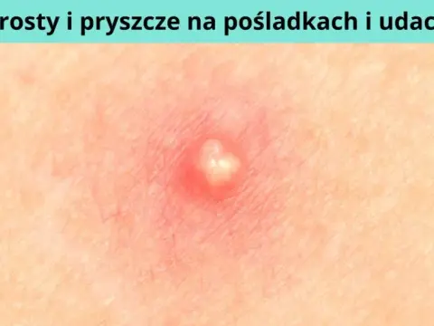 Jak powstaje pryszcz i co naprawdę wpływa na ich pojawianie się