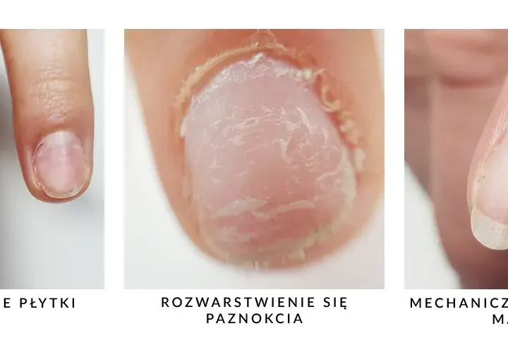 Jak wyrównać płytkę paznokcia i uniknąć nieestetycznych nierówności