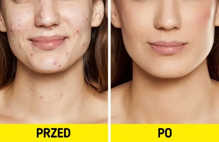 Jak pozbyć się pryszczy na twarzy - skuteczne metody i porady