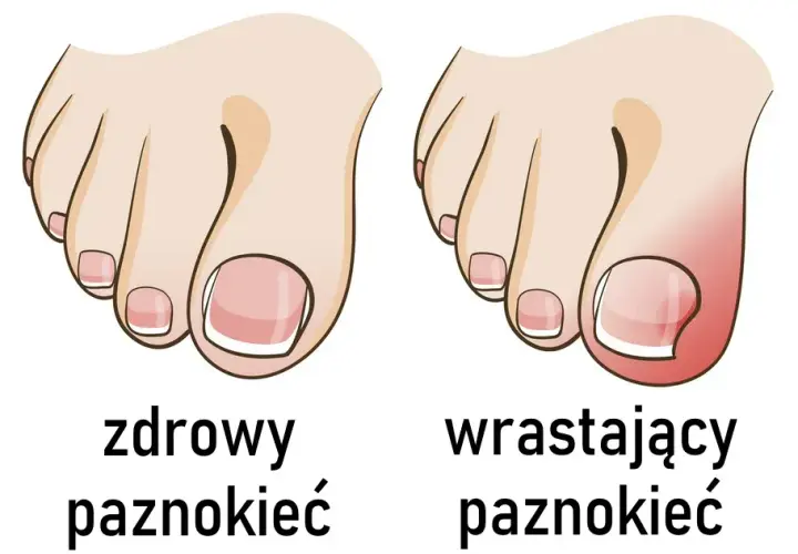 Jak wyciąć wrastający paznokieć i uniknąć bólu oraz powikłań