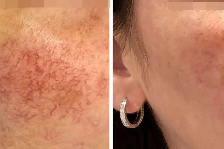 Jak długo goi się skóra po laserze frakcyjnym? Czas regeneracji