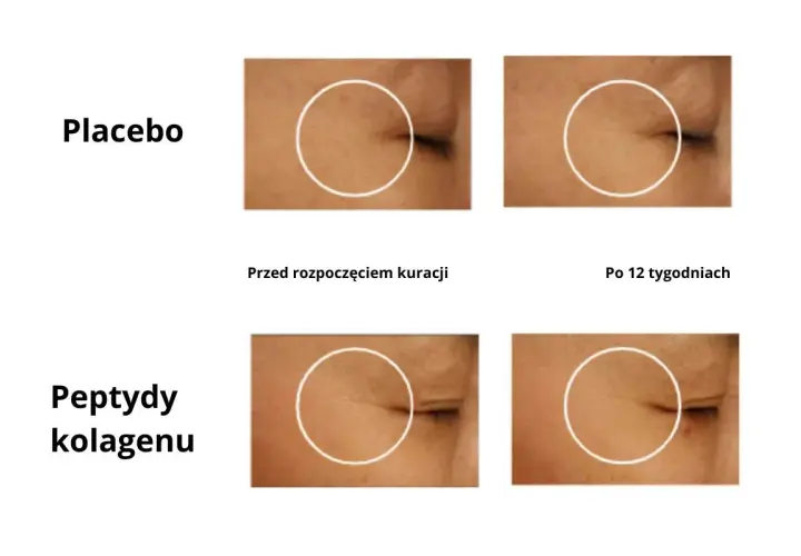 Porównanie skóry przed i po 12 tygodniach: placebo vs. peptydy kolagenu. Sprawdź collagen drink dr max opinie.
