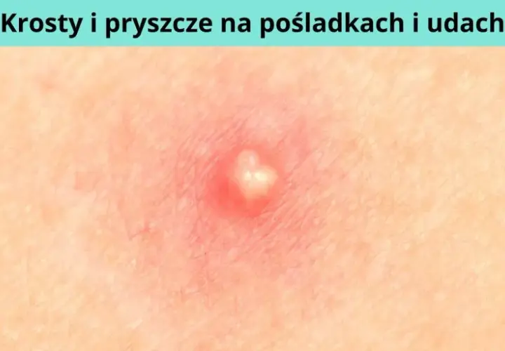 Jak powstaje pryszcz i co naprawdę wpływa na ich pojawianie się