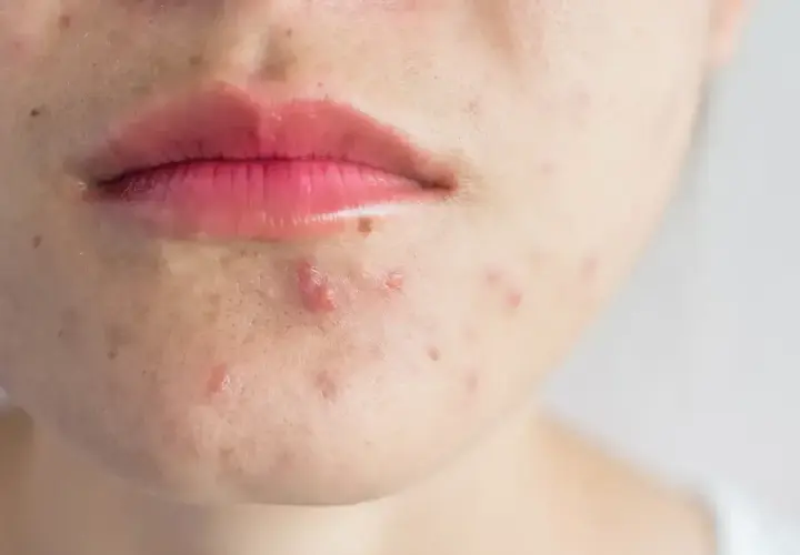 Skóra wokół ust z widocznymi pryszczami i zaczerwienieniami. Czasem strup po pryszczu goi się długo.