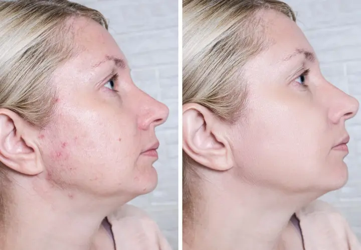 Przed i po: skóra z niedoskonałościami i zaczerwienieniami po zastosowaniu Acne Derm. Efekty widoczne!