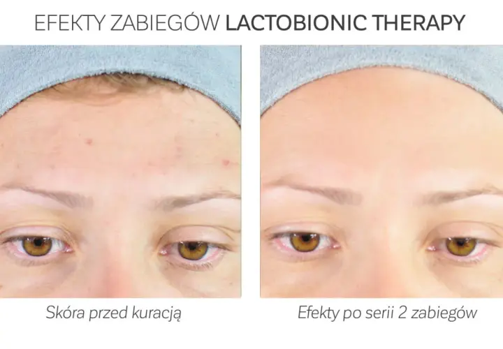 Przed i po zabiegu z kwasem laktobionowym: skóra z niedoskonałościami staje się gładka i czysta.