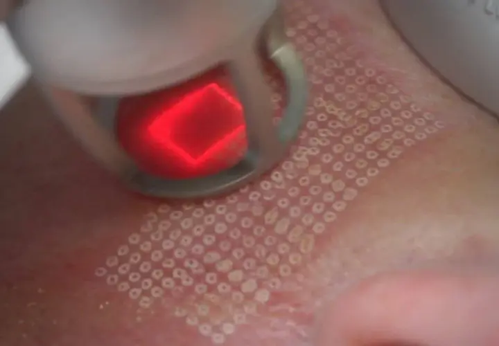 Jak wygląda zabieg laser frakcyjny? Efekty i co warto wiedzieć