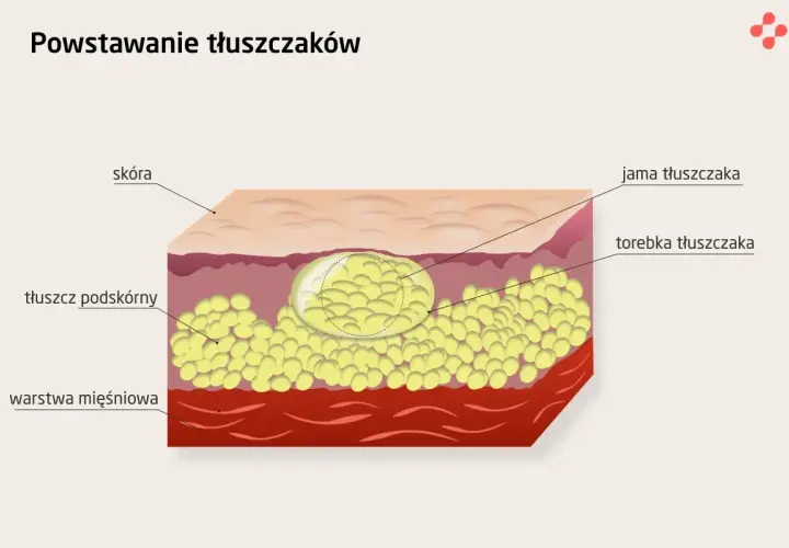 Przekrój skóry ukazujący powstawanie podskórnych gule tłuszczowe. Widoczna warstwa tłuszczu podskórnego, torebka i jama tłuszczaka.