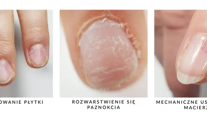 Jak wyrównać płytkę paznokcia i uniknąć nieestetycznych nierówności