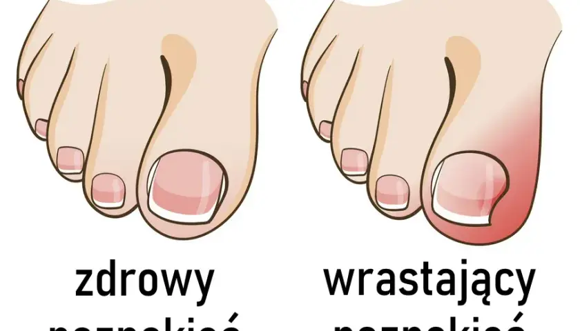 Jak wyciąć wrastający paznokieć i uniknąć bólu oraz powikłań