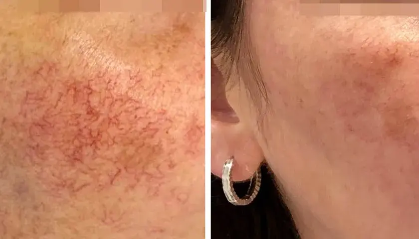 Jak długo goi się skóra po laserze frakcyjnym? Czas regeneracji