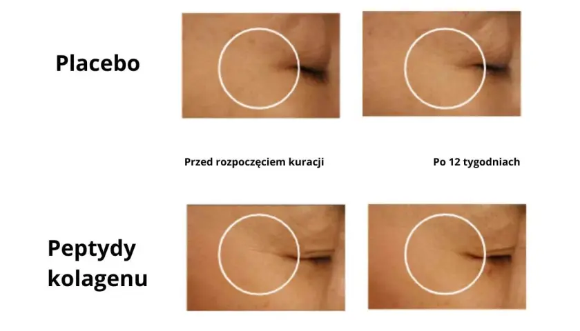 Porównanie skóry przed i po 12 tygodniach: placebo vs. peptydy kolagenu. Sprawdź collagen drink dr max opinie.