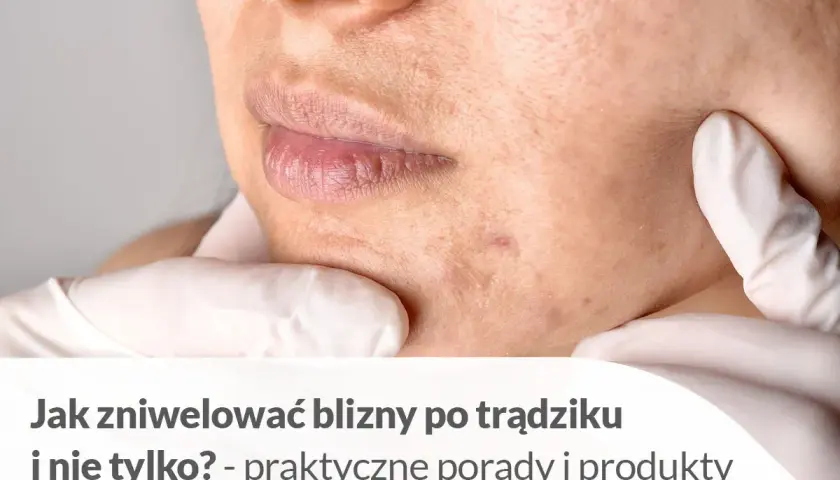 Skóra z bliznami po pryszczach, z tekstem "Jak zniwelować blizny po trądziku i nie tylko?".