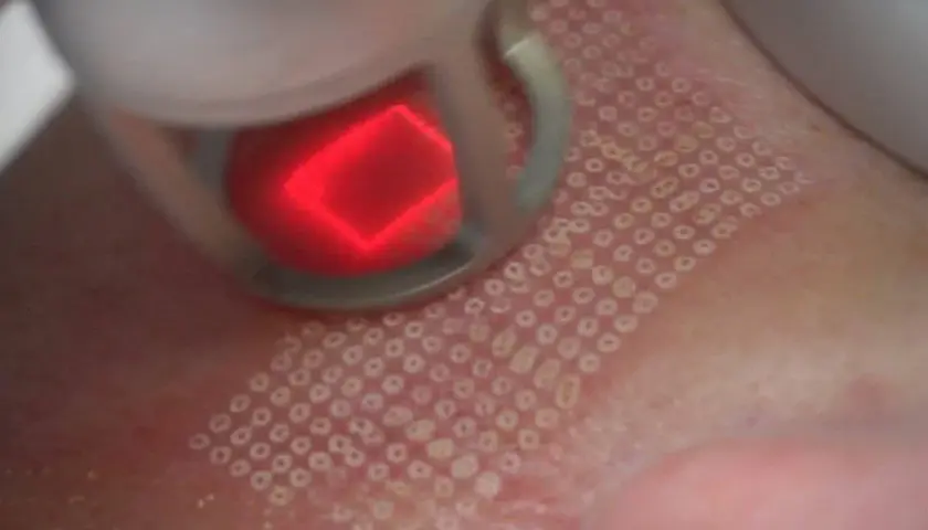 Jak wygląda zabieg laser frakcyjny? Efekty i co warto wiedzieć