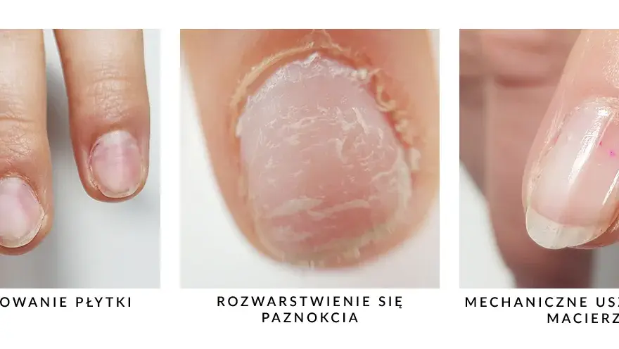 Jak wyrównać płytkę paznokcia i uniknąć nieestetycznych nierówności