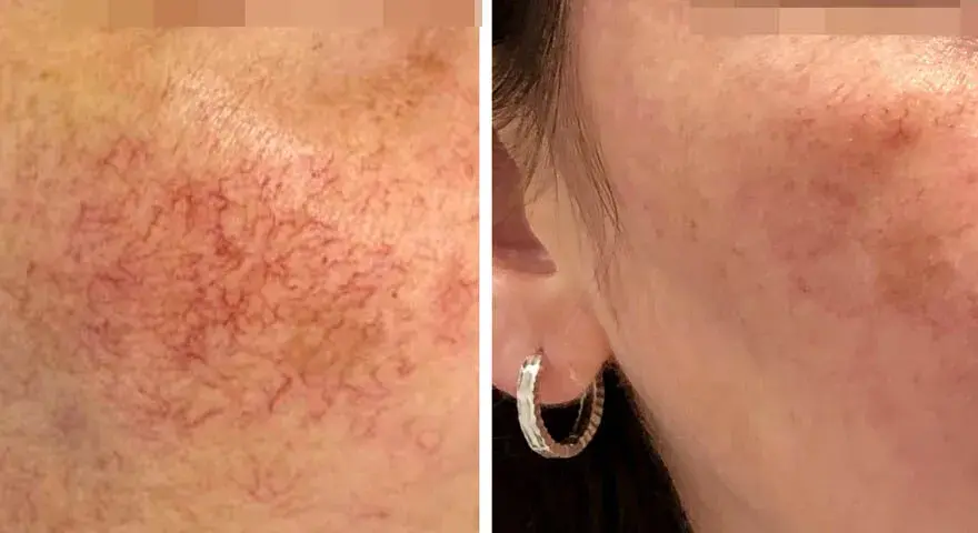 Jak długo goi się skóra po laserze frakcyjnym? Czas regeneracji