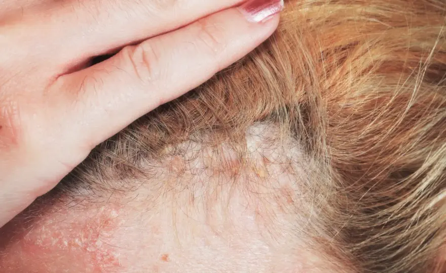 Strupy na głowie - skąd się biorą i kiedy iść do dermatologa