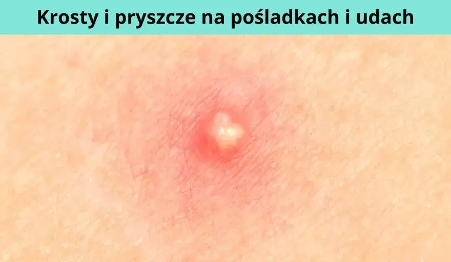 Jak powstaje pryszcz i co naprawdę wpływa na ich pojawianie się