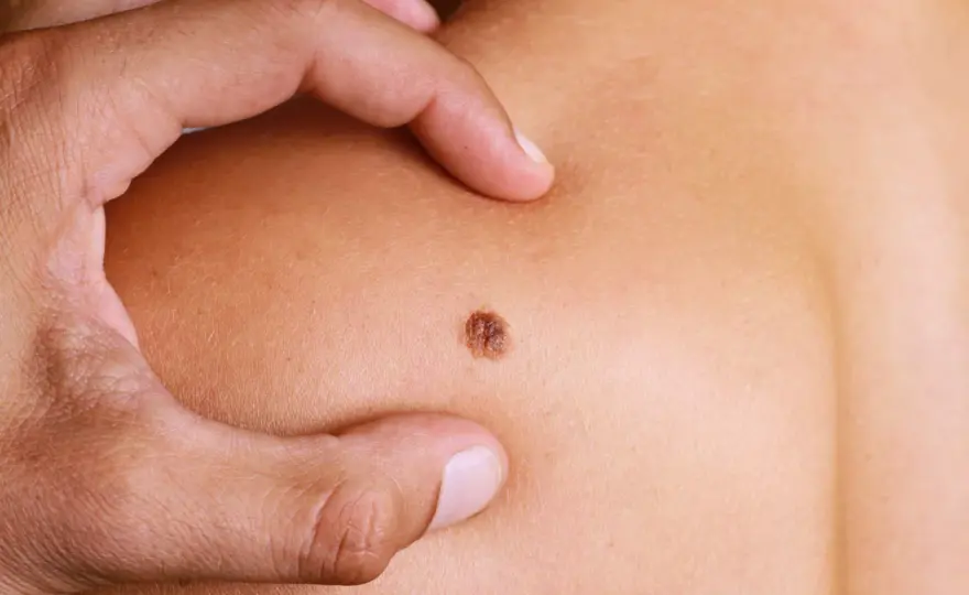 Bolący pieprzyk jak pryszcz - co oznacza i kiedy iść do dermatologa