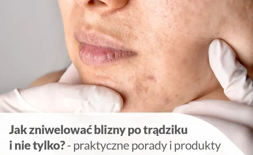 Rany po pryszczach - co naprawdę przyspiesza gojenie?