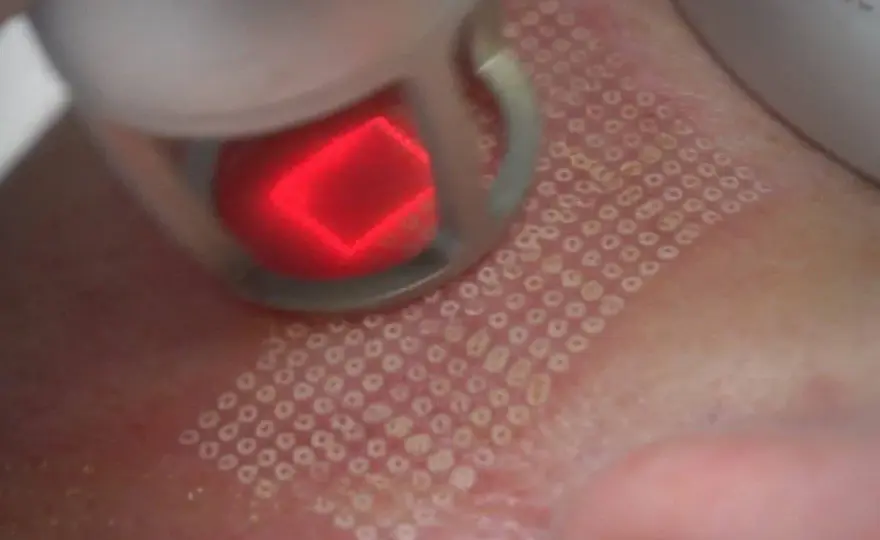 Jak wygląda zabieg laser frakcyjny? Efekty i co warto wiedzieć