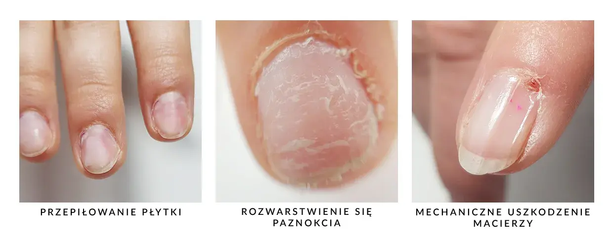 Jak wyrównać płytkę paznokcia i uniknąć nieestetycznych nierówności