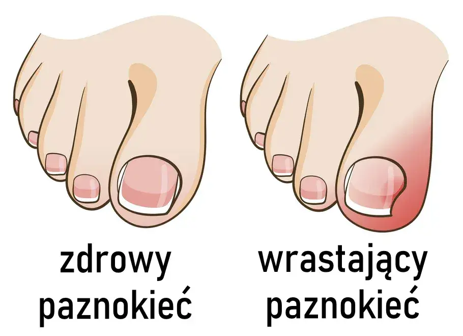 Jak wyciąć wrastający paznokieć i uniknąć bólu oraz powikłań