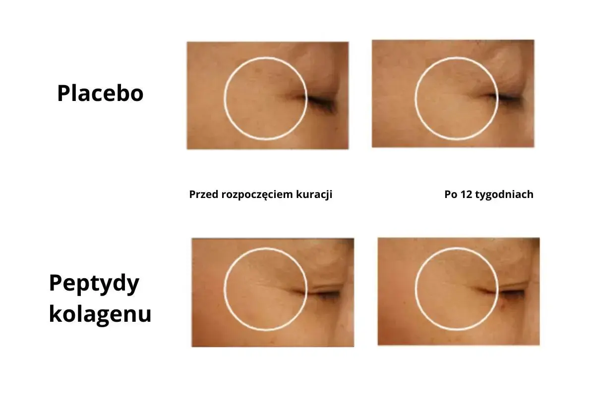 Porównanie skóry przed i po 12 tygodniach: placebo vs. peptydy kolagenu. Sprawdź collagen drink dr max opinie.
