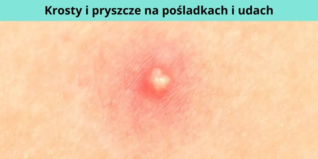 Jak powstaje pryszcz i co naprawdę wpływa na ich pojawianie się