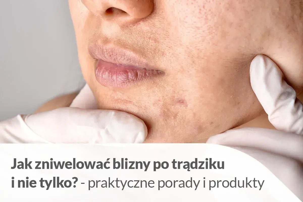 Skóra z bliznami po pryszczach, z tekstem "Jak zniwelować blizny po trądziku i nie tylko?".
