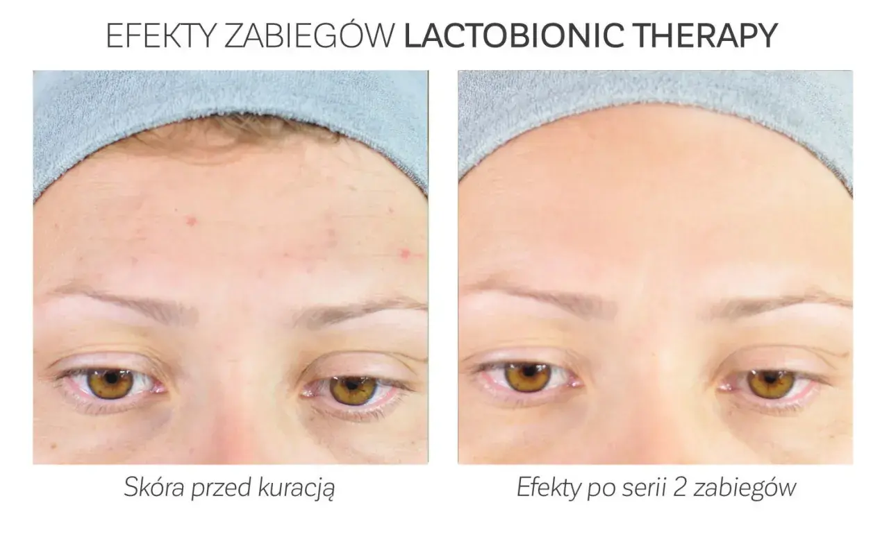 Przed i po zabiegu z kwasem laktobionowym: skóra z niedoskonałościami staje się gładka i czysta.