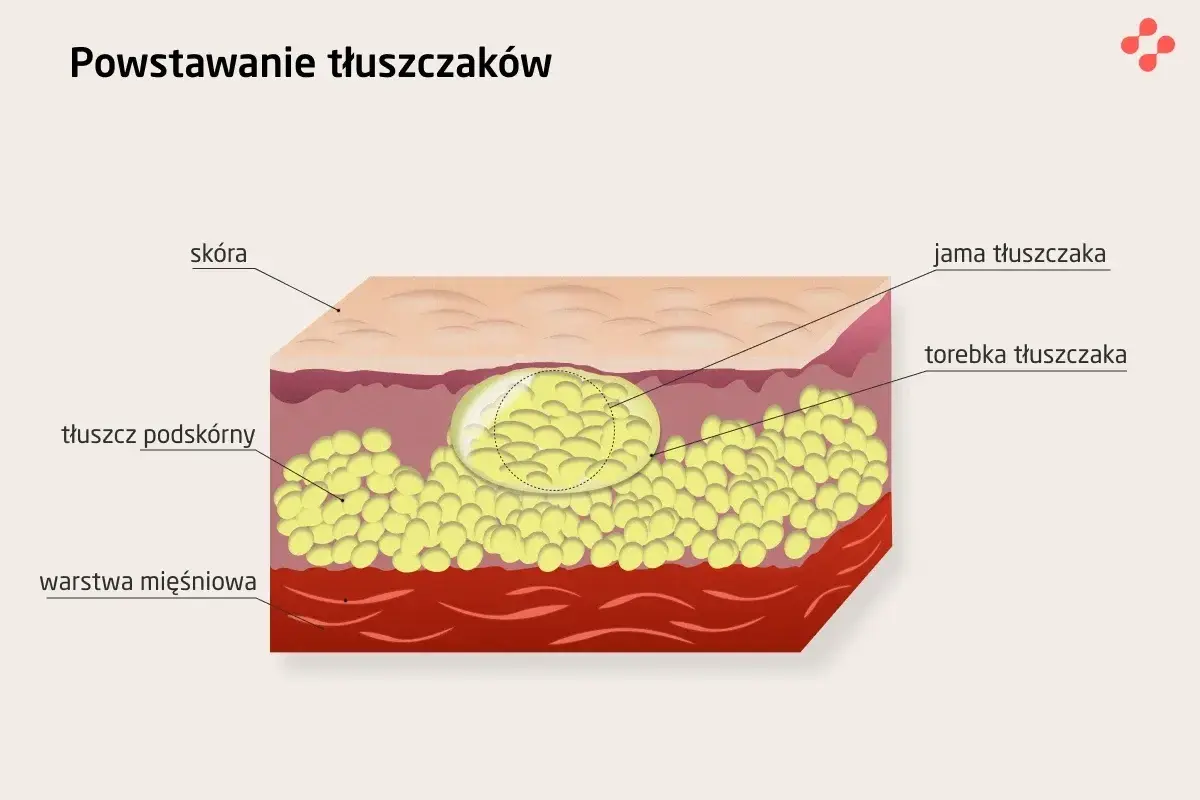 Przekrój skóry ukazujący powstawanie podskórnych gule tłuszczowe. Widoczna warstwa tłuszczu podskórnego, torebka i jama tłuszczaka.