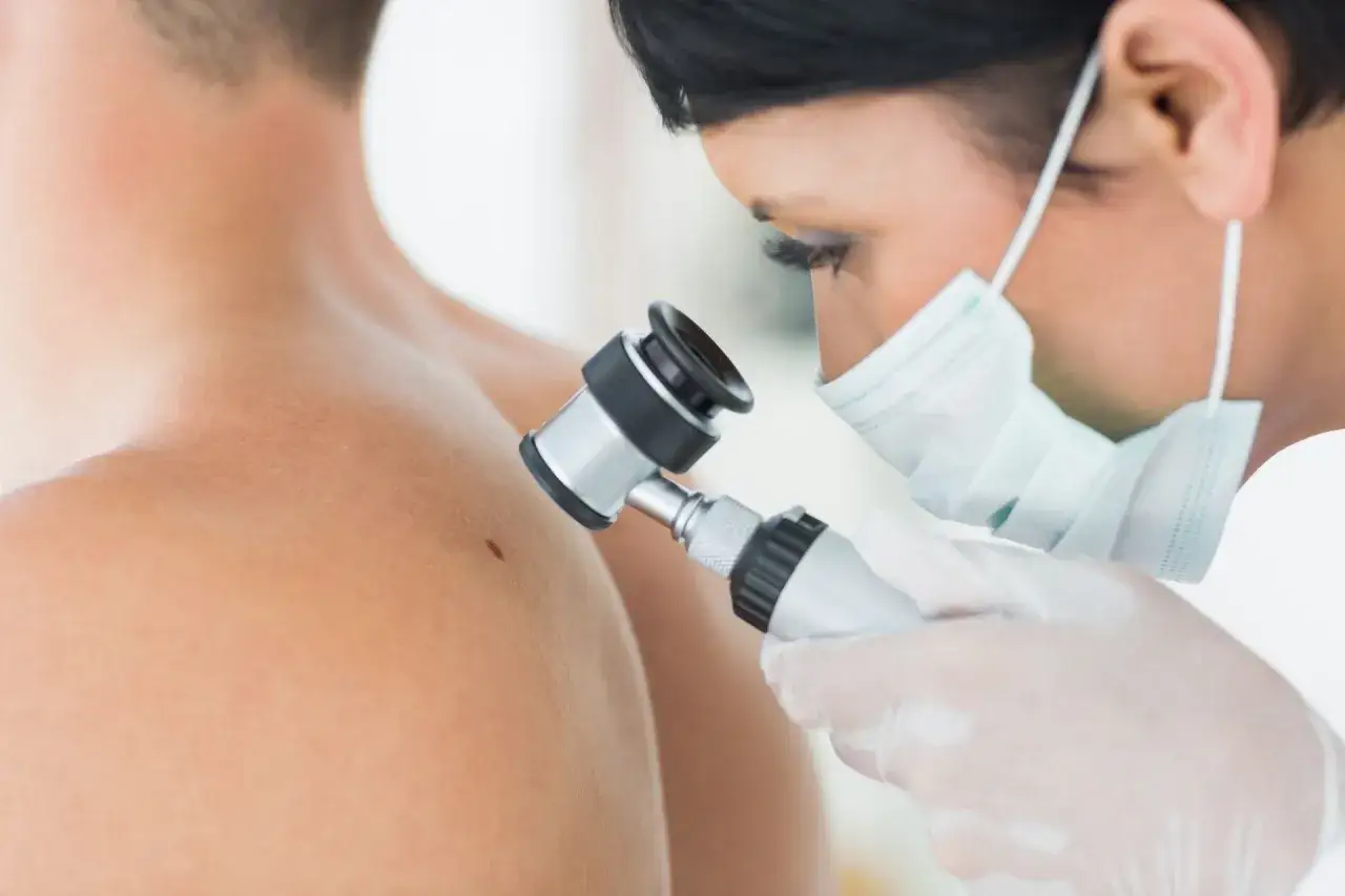 Dermatolog bada pieprzyk za pomocą dermatoskopu, sprawdzając, czy nie ma stanu zapalnego.