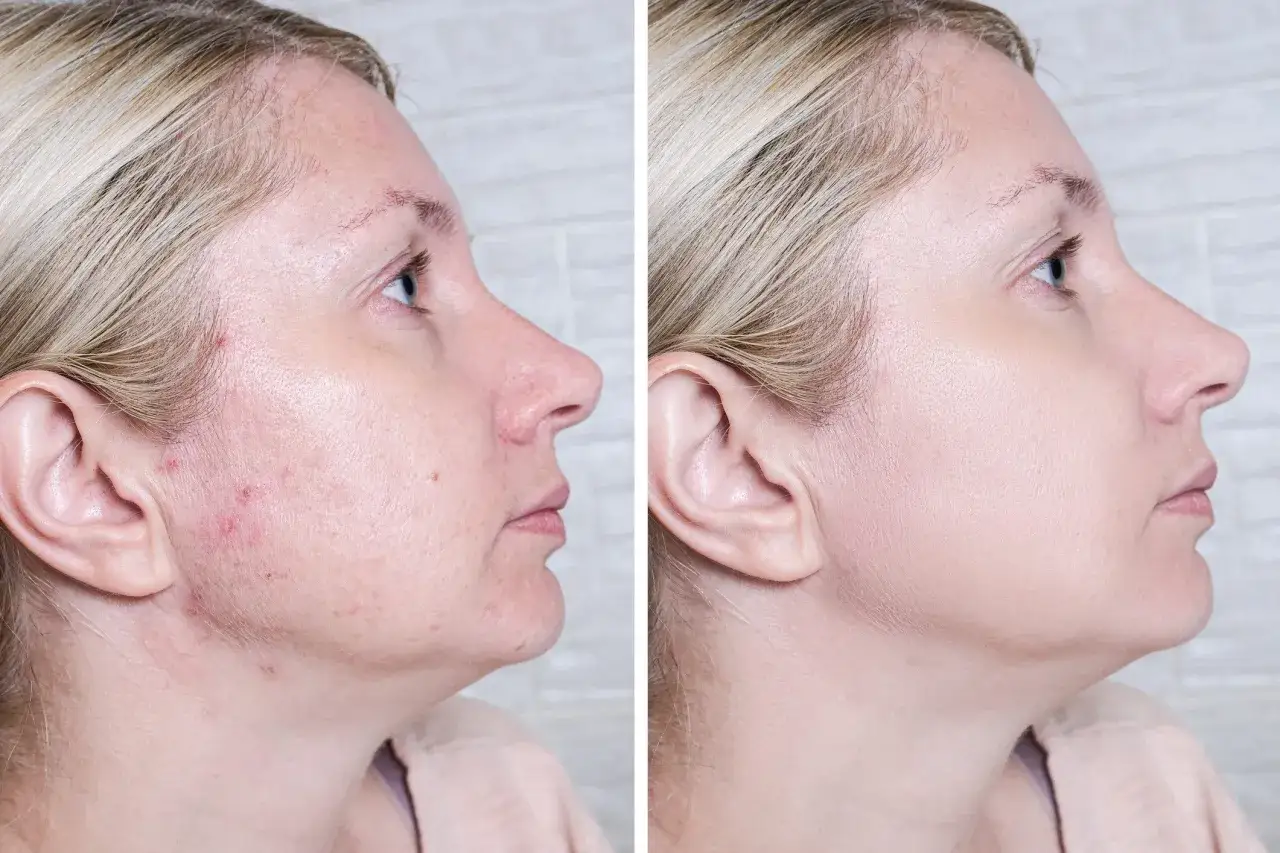 Przed i po: skóra z niedoskonałościami i zaczerwienieniami po zastosowaniu Acne Derm. Efekty widoczne od razu!