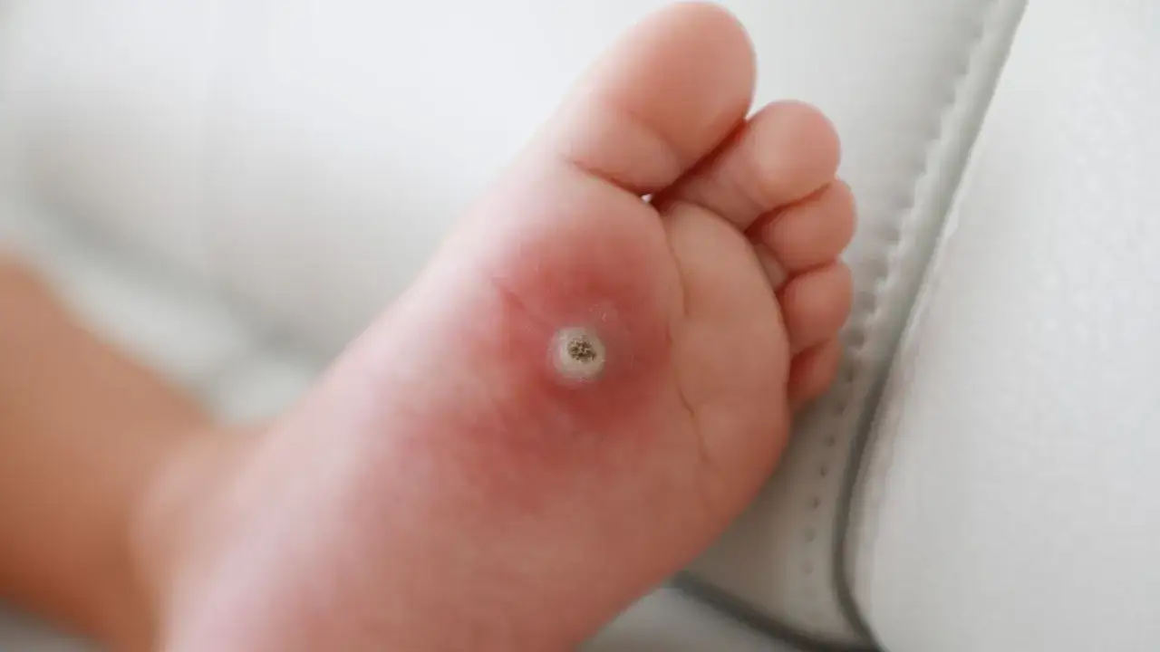 Małe, okrągłe zgrubienie na stopie dziecka, które wygląda jak kurzajka. Skóra wokół jest lekko zaczerwieniona.