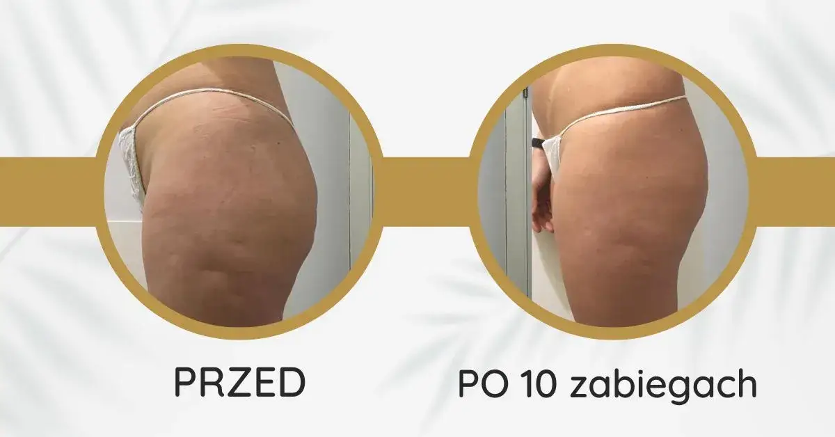 Zdjęcie Co lepsze: endermologia czy kriolipoliza - porównanie skuteczności i efektów