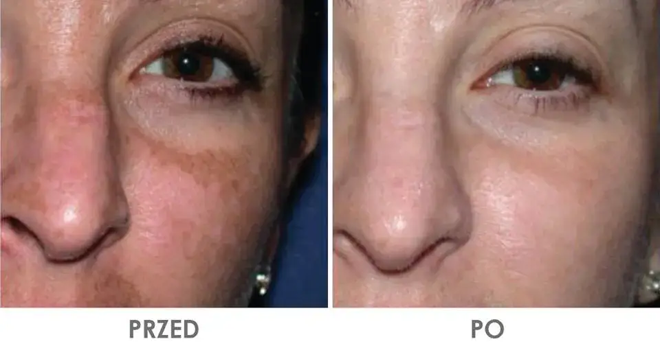 Zdjęcie Gdzie kupić deep phyto peeling? Sprawdź najlepsze opcje i ceny
